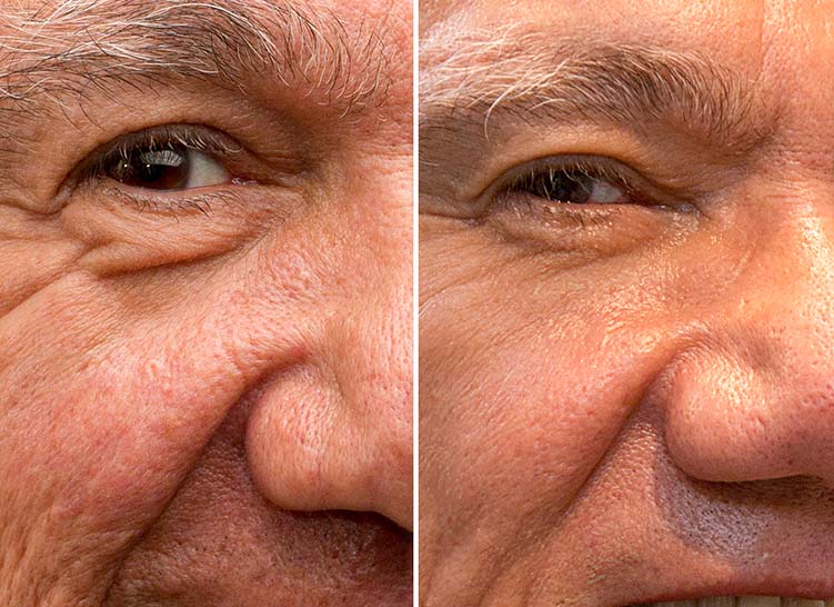 Close-up of an older man's skin texture before and after treatment.