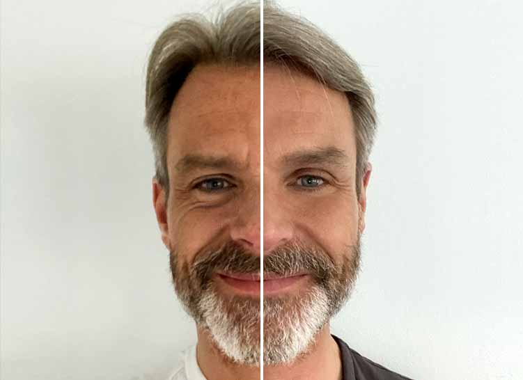 Man with a split-screen effect showing different skin condition.