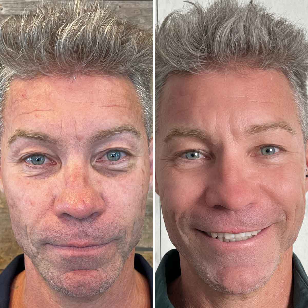 Two close-up photos of a middle-aged man’s face showing a before-and-after comparison with visible skin improvements.