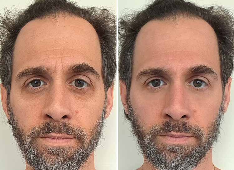 A side-by-side comparison of a man's face showing significant skin condition improvement.