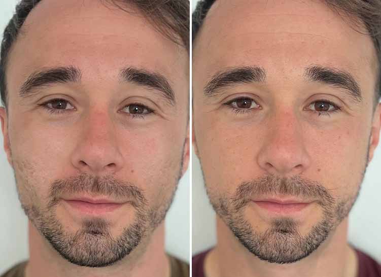 Man's face, before and after applying Particle Scar Gel.