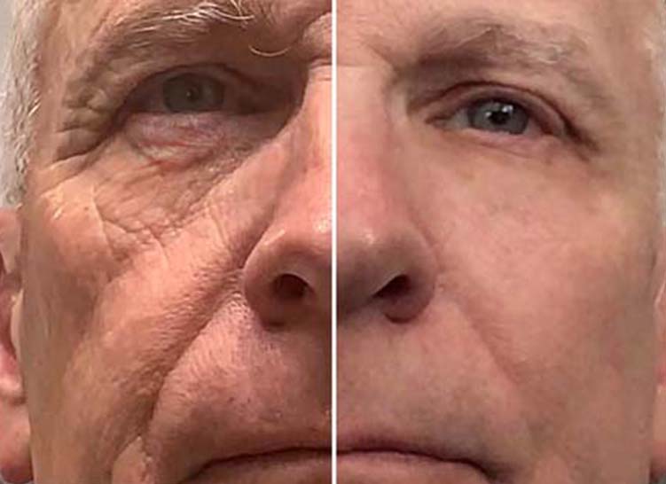 An older man's face showing the effects of anti-aging treatment, with wrinkles on the left side and smoother skin on the right side.