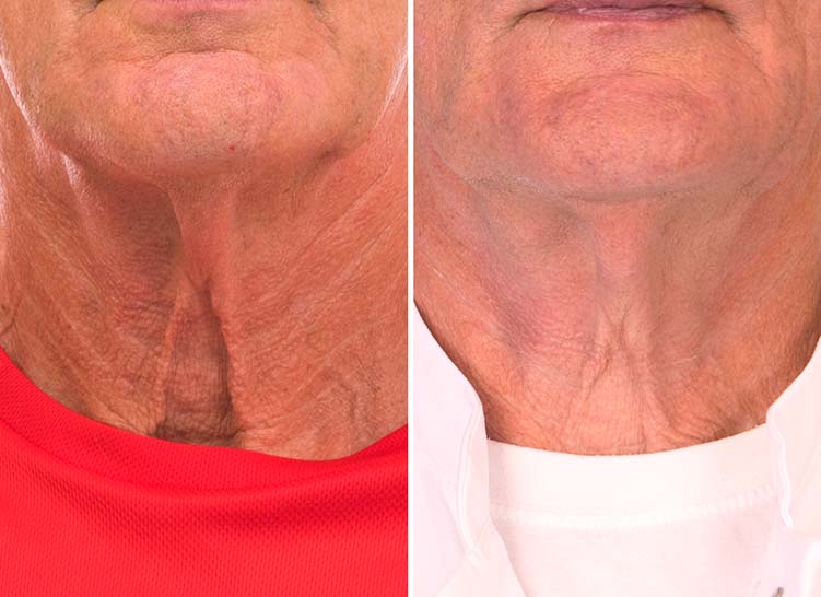 Showing the contrast between the skin on a man's neck prior to and post-application of a cream to highlight the change.