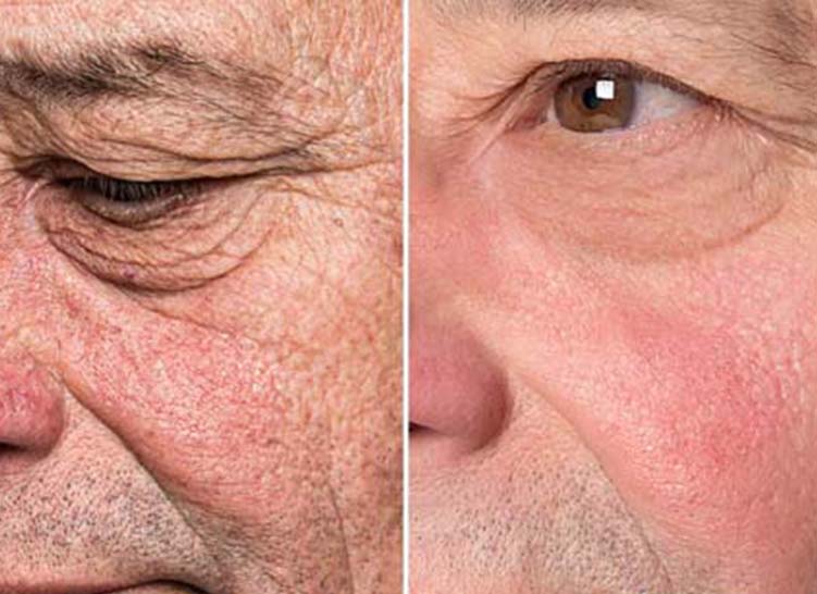 Close-up of an older man's cheek, before and after skincare treatment.