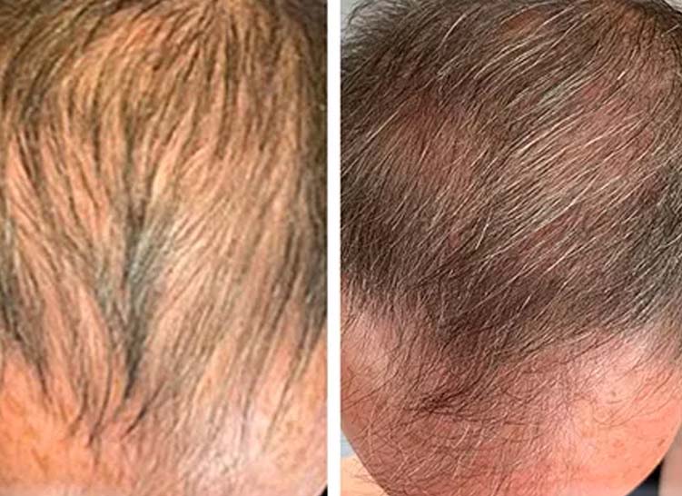 Two images show the top of a person's head, highlighting significant hair regrowth from thin to fuller hair.