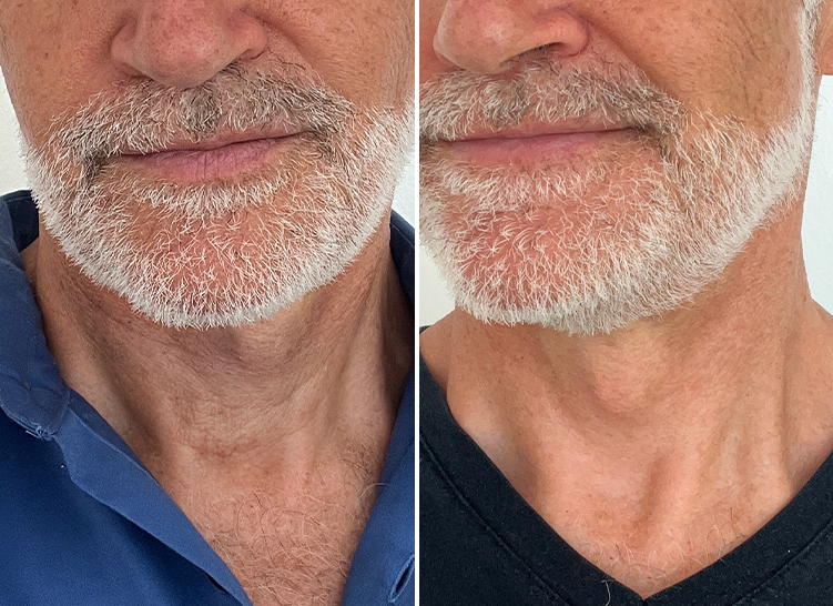 Two photos of man's neck before and after applying a cream.